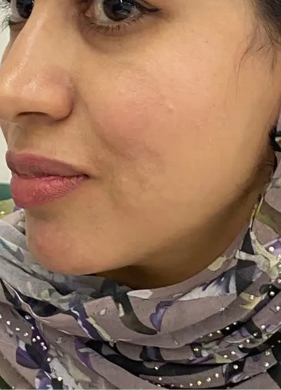 بعد از درمان 